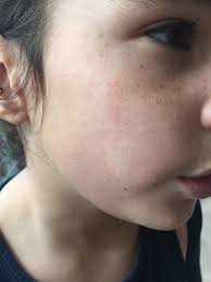 Image result for ekzema face