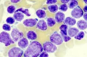 Image result for Acute Leukemia