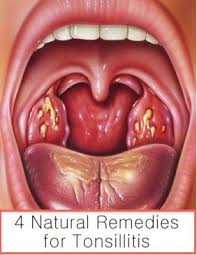 Black And White Spots On Tonsils 4 Natural Remedies For Tonsillitis Tonsilitis Remedy Homeopathic Remedies Natural Remedies