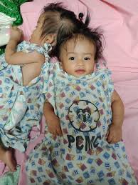 Windows on the park condominium at bandar tun hussien onn, cheras. My Craniopagus Twins Need Funds For Their Surgery Maricel Villaluz Airfunding