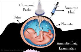 Meconium Aspiration Syndrome Causes Symptoms Diagnosis Complications Treatment