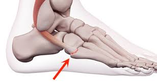 Peroneal tendon injuries may be acute (occurring suddenly) or chronic (developing over a period of time). Outside Foot Pain Symptoms Causes Treatment Rehabilitation
