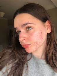 Image result for acne face