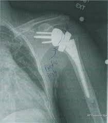 Image result for Shoulder XRay