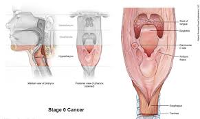 Throat cancer occurs in the throat. Early Stage Throat Cancer Images Celine Dion Songs Age