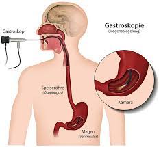 Infos Zur Gastroskopie Chirurgie Kees