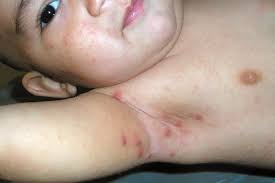Image result for scabies symptoms