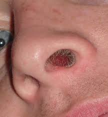 For boys and girls, kids and adults, teenagers and toddlers, preschoolers and older kids at school. Nasal Hair Wikipedia