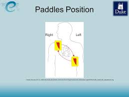 Recent guidelines state that the sternal paddle should be placed below the right clavicle in the. Defibrillators Who Defibrillator External Automated Semiautomated From The Publication Core Medical Equipment Geneva Switzerland Ppt Video Online Download