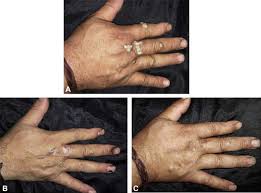 Warts are the cutaneous manifestations of human papilloma virus (hpv) that may exist in different the use of oral acitretin in the treatment of recalcitrant warts is under studied in literature where. Intralesional Versus Intramuscular Bivalent Human Papillomavirus Vaccine In The Treatment Of Recalcitrant Common Warts Journal Of The American Academy Of Dermatology