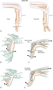 Image result for Elson Extensor Tendon Test