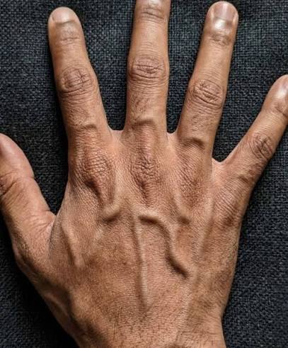 If your veins are visible in your hand, it is a signal of ca… See more