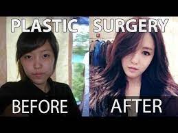 Double Jaw Surgery Asymmetrical Face Korea Plastic Surgery Let Me In Tv Show Youtube Kpop Plastic Surgery Plastic Surgery Surgery