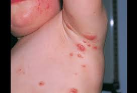 When they bite, it causes skin response in the form of itching which usually intensifies at night. Bites And Infestations Pictures Of Bug Bites Stings Allergies And Infections