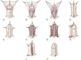 Image result for Chordee