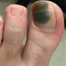 That dark streak could be melanoma, the most serious type of skin cancer. Toenail Subungal Melanoma Symptoms Causes And Treatments