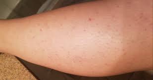 What do ingrown hairs look like? Ot But Desperate For Help Severe Ingrown Hairs On Legs September 2018 Babies Forums What To Expect