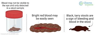 Image result for blood in stool human poop