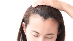 Those woman who have lesser hair and thin hair can appear bald and scalpy in several cases. How To Stop And Regrow A Receding Hairline Best Treatments Allure