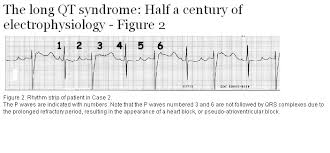 The Long Qt Syndrome Half A Century Of Electrophysiology British Columbia Medical Journal