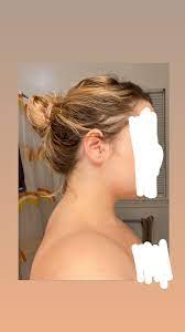 We did not find results for: Is This A Buffalo Hump Cushings