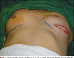 Poland syndrome is a congenital condition that may affect any individual. Figure 1 From Complication After Breast Implantation In Poland Syndrome Semantic Scholar