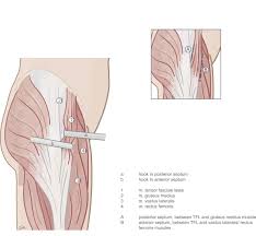 Hauptsächlich spannt er die fascia lata und seinen verstärkungsstreifen (unterstützung der zuggurtung) . Septocutaneous Tensor Fasciae Latae Perforator Flap For Breast Reconstruction Radiological Considerations And Clinical Cases Journal Of Plastic Reconstructive Aesthetic Surgery