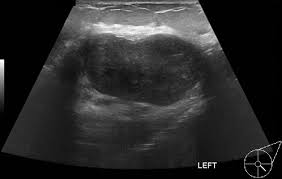 Symptoms of metastatic involvement can arise from as early as a few . Malignant Phyllodes Tumor Radiology Case Radiopaedia Org