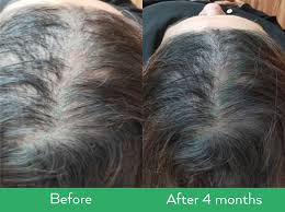 The year 2013 was a great year at least a wonderful discovery was made. Neofollics Anti Grey Hair Tablets Hair Growth Specialist