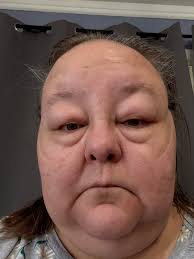 Anyone have a kidney biopsy? Is it a difficult procedure?