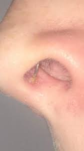 Durch diese bakterien entsteht eine schmerzhafte eitrige. Ist Mein Septum Entzundet Wenn Ja Was Tue Ich Dagegen Nase Septum Piercing
