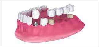 For those that feature any porcelain surface types of crowns., the minimal restoration thickness that's typically or ideally required lies on. Tips For All Ceramic Crown Cementation