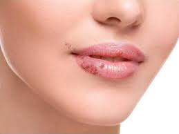 If your lip pimple looks like whitehead,. Find Out What The Appearance Of White Spots On Your Lips Indicates Statesboro Herald