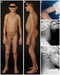 Diabetes complications/drug therapy* diabetes mellitus/drug therapy* female; Congenital Generalized Lipodystrophy Type 4 Cgl4 Associated With Myopathy Due To Novel Ptrf Mutations Abstract Europe Pmc
