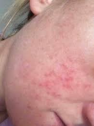 If you are having dry skin and cracking in the hands and legs, then it is an indication that you may be pregnant with a baby boy. Acne Carrying A Boy Or Girl