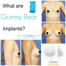 Pin On Breast Implant Options Current And Future