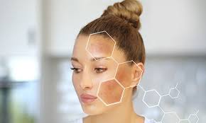 Image result for Melasma