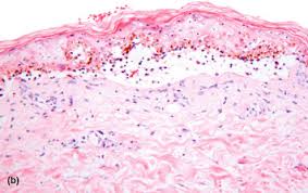 Image result for Erythema Multiforme