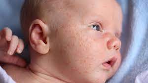 If your baby has dry skin, there are ways to improve it. Is It Baby Acne A Rash Or Something Else