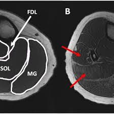 The muscles within the calf correspond to the posterior compartment of the leg. T1 Weighted Images Of Lower Leg Muscles Representative T1 Weighted 3 D Download Scientific Diagram