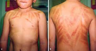 Yüzünüzü uyguladığınız yağ ile kaydırmanız gerekiyor. Cao Gio Coin Rubbing Springerlink