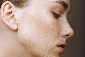 Alle neuheiten und innovationen von caudalie für gesicht & körper auf unserer offiziellen internetseite. Pigmentflecken Creme Was Hilft Wirklich Brigitte De