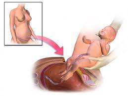 Procedure, reasons, recovery, and complications. During Covid 19 First Wave The Proportion Of Caesarean Section Deliveries Done Under General Anaesthesia Halved