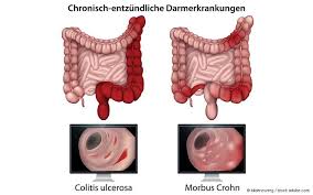 Fettes Essen Und Antibiotika Fordern Ced Gelbe Liste