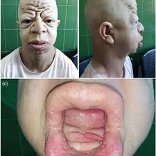 Frontal and lateral photographs of our patient. (a, b) frontal bossing,... 