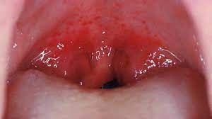 2.9k views answered >2 years ago. Why Do I Have Red Spots On My Throat