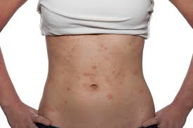 Here are some of the tests you may need: Breaking Out In A Rash Could Be A Sign Of Cancer Here S How Tell If You Are At Risk