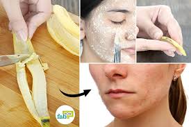 10 Ways To Use Banana Peel For Face Teeth And Skin Fab How After one week i was amazed black dots had been drawn banana peel for warts: 10 ways to use banana peel for face