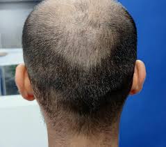 Nordwood scale 7; thin donor are