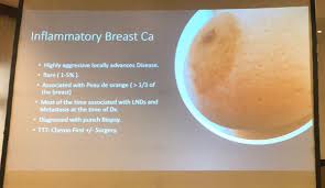 Inflammatory breast cancer (ibc) is a rare but rapidly growing cancer that gives rise to several signs and symptoms, mostly within a span of three to six months. Nisreen Maghraby On Twitter Breast Cancer Fibroadenoma Phyllodes Inflammatory Breast Ca Dr Shaimaa Dashti Womensurgeonsk1 Awhec1